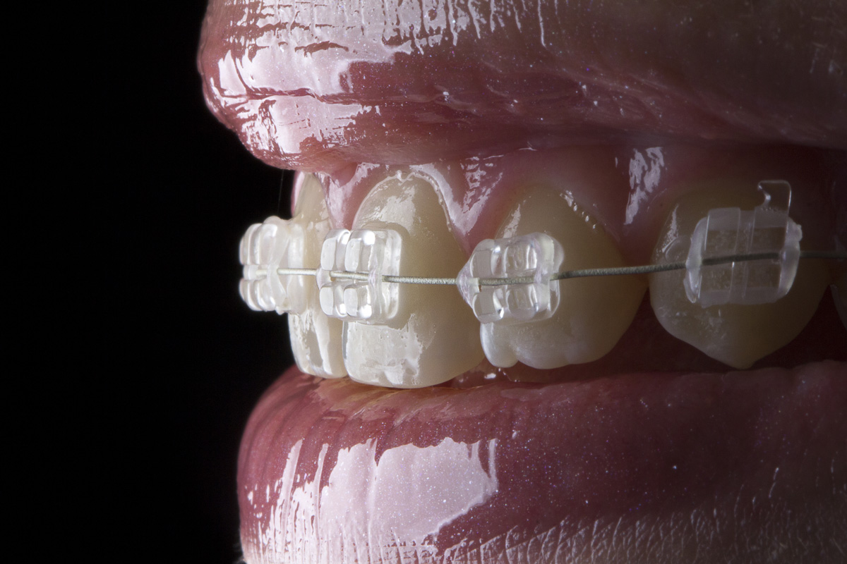 Aparat Ortodontyczny Estetyczny Prime Dental