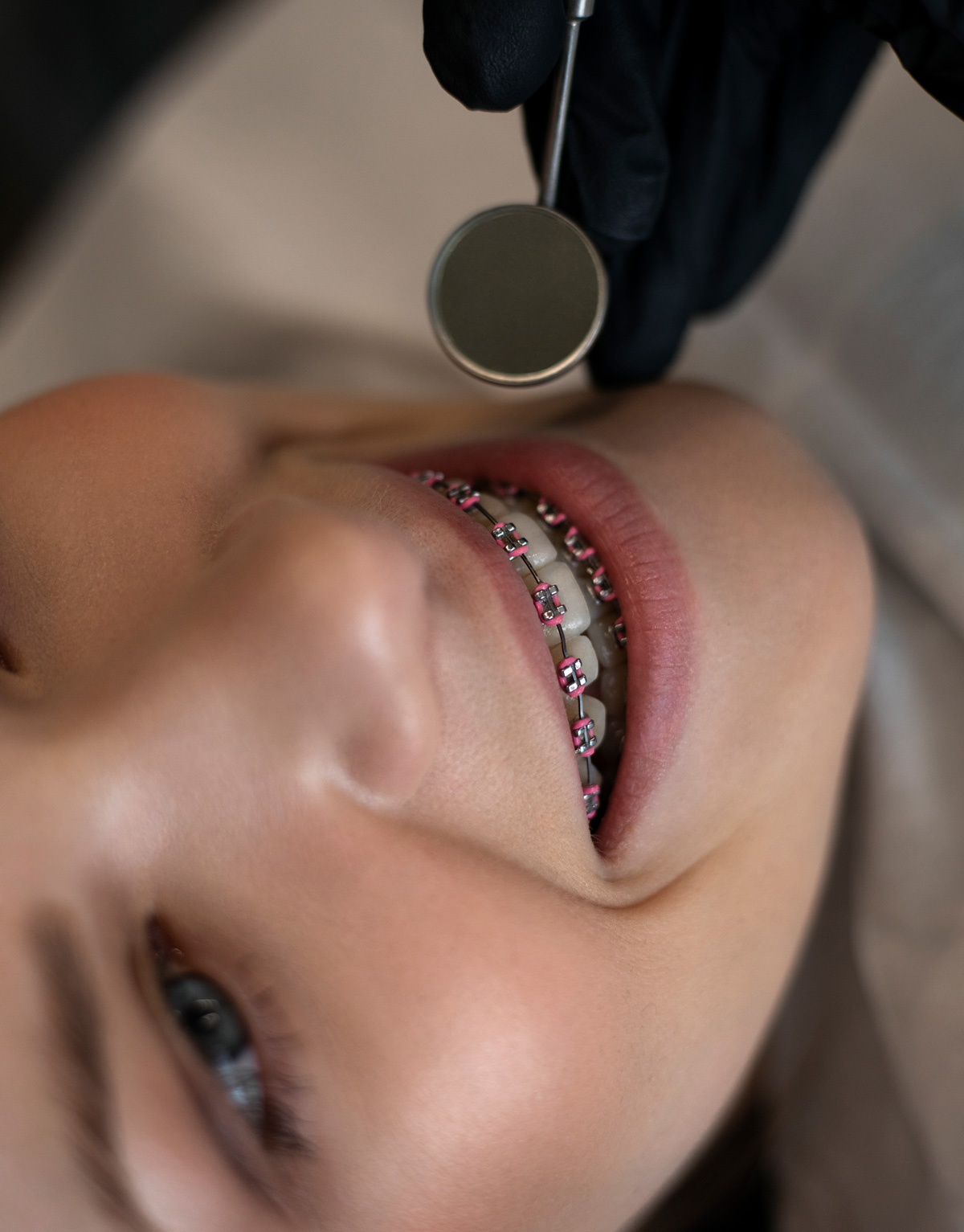 Aparat Ortodontyczny Metalowy Prime Dental