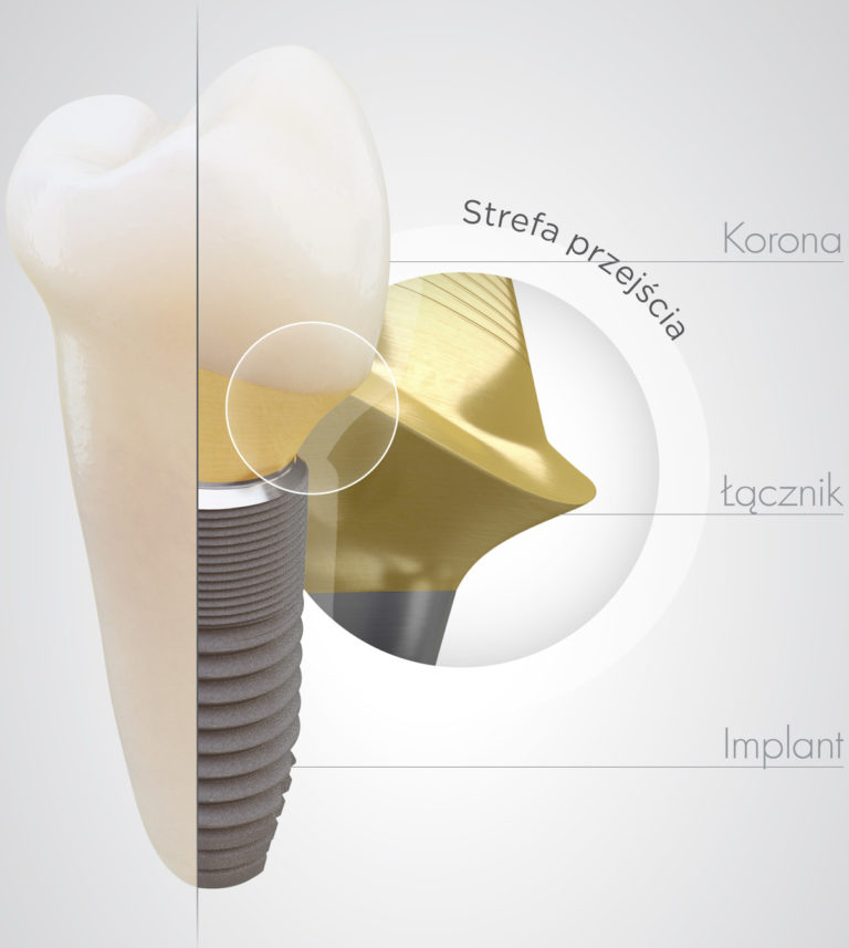 Prime Dental Implanty Wrocław