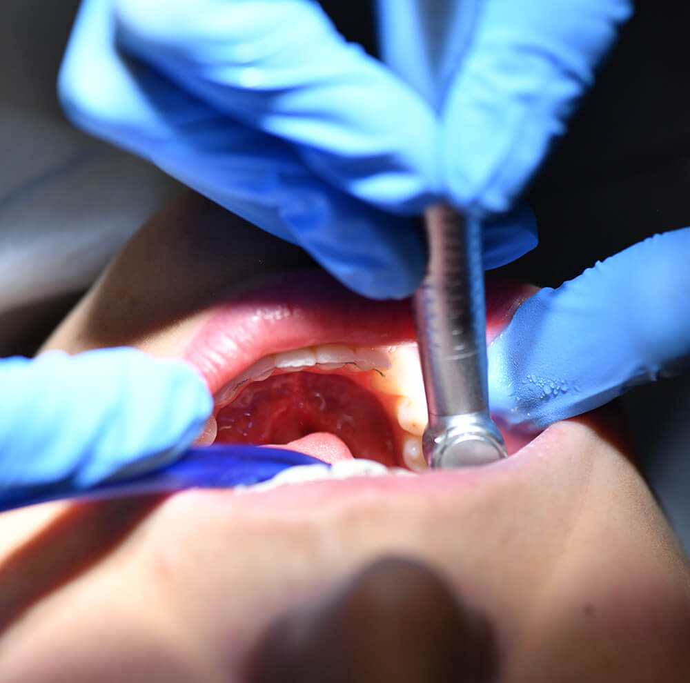 Bezbolesny Demontaż Aparatu Ortodontycznego Prime Dental