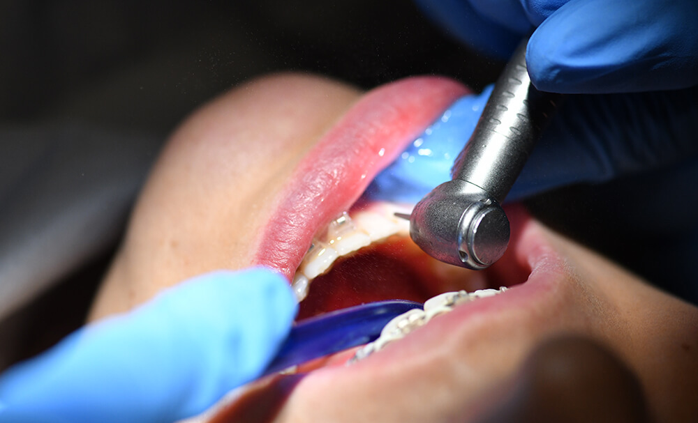 Demontaż Aparatu Ortodontycznego w Prime Dental